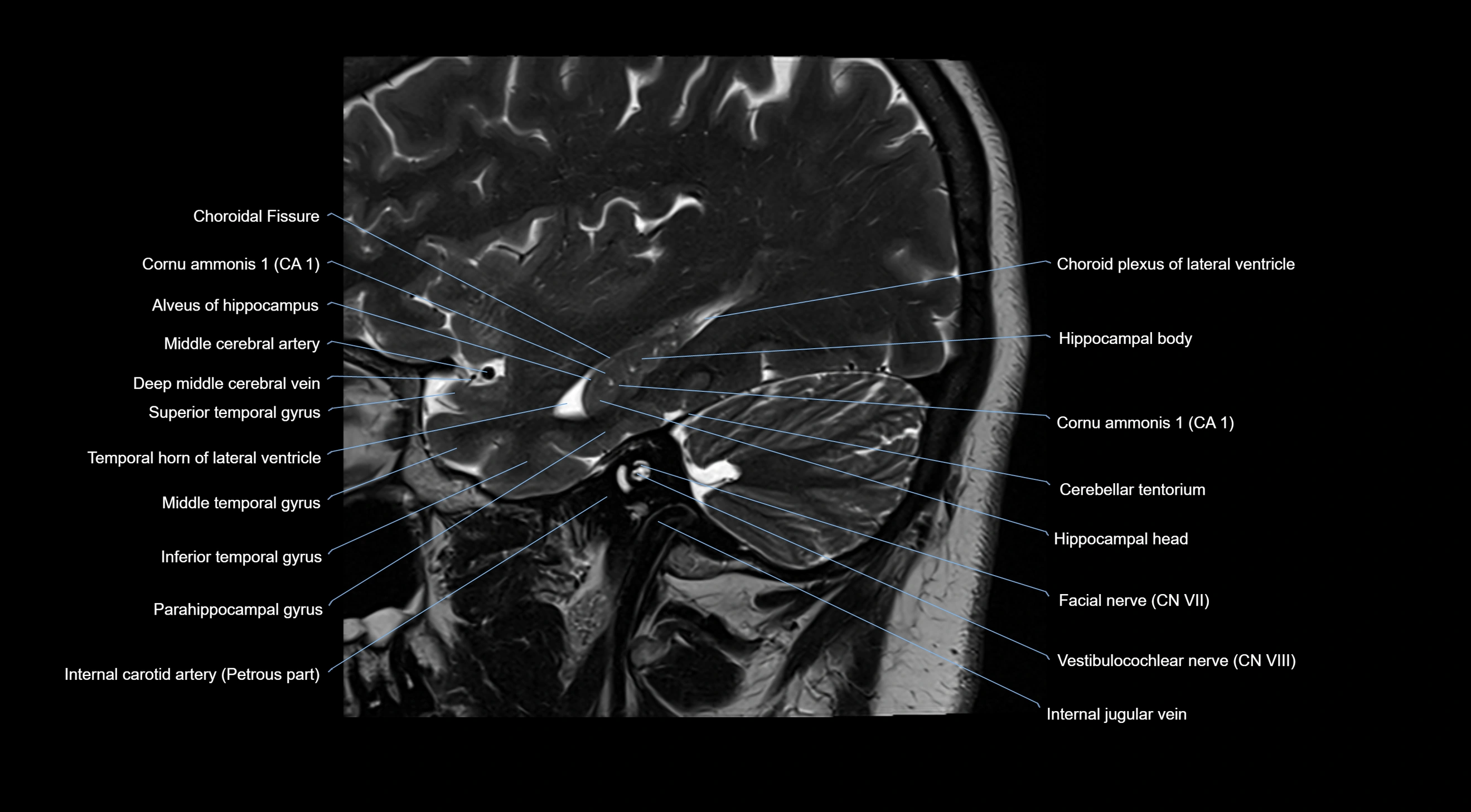 MRI brainstem & basal ganglia anatomy labelled  3T MRI images -img-10001-00010.webp